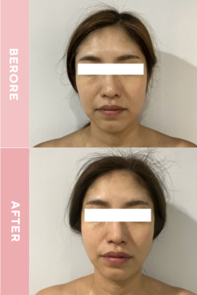 たるみ改善＆引き締め、フェイシャル、ビフォーアフター